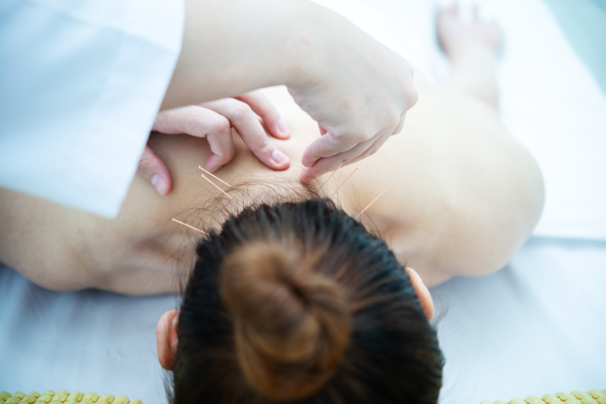 Acupuntura sendo realizada em paciente deitado